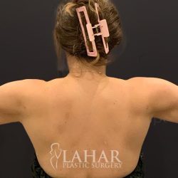 Arm Liposuction Before & After Patient #1583