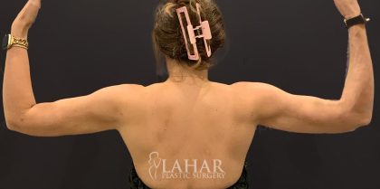 Arm Liposuction Before & After Patient #1583