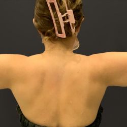 Arm Liposuction Before & After Patient #1583