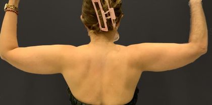 Arm Liposuction Before & After Patient #1583