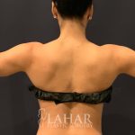 Arm Liposuction Before & After Patient #1584