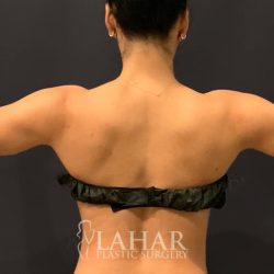 Arm Liposuction Before & After Patient #1584