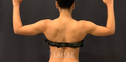 Arm Liposuction Before & After Patient #1584