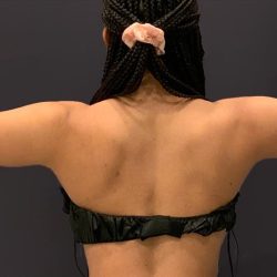 Arm Liposuction Before & After Patient #1584