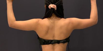 Arm Liposuction Before & After Patient #1584