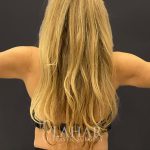Arm Liposuction Before & After Patient #1585