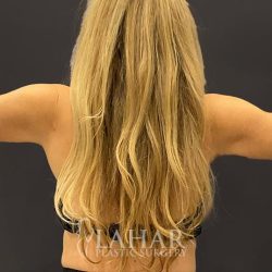 Arm Liposuction Before & After Patient #1585
