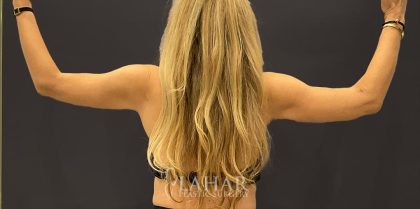 Arm Liposuction Before & After Patient #1585