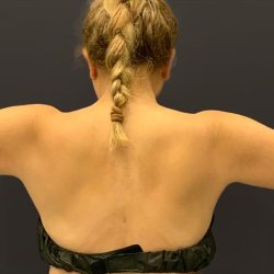 Arm Liposuction Before & After Patient #1585