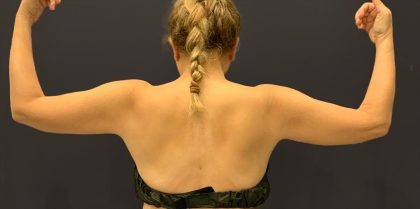 Arm Liposuction Before & After Patient #1585
