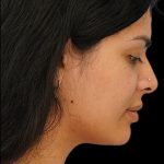 Chin Liposuction Before & After Patient #1557
