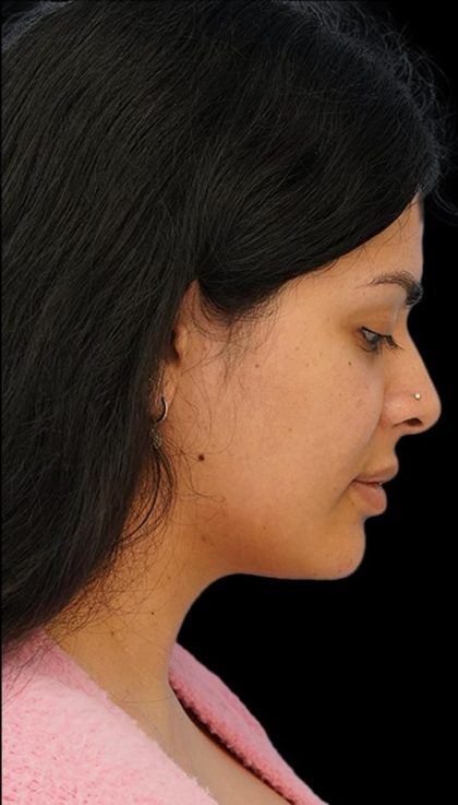 Chin Liposuction Before & After Patient #1557