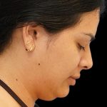 Chin Liposuction Before & After Patient #1557
