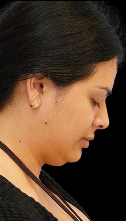 Chin Liposuction Before & After Patient #1557