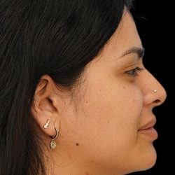 Chin Liposuction Before & After Patient #1557