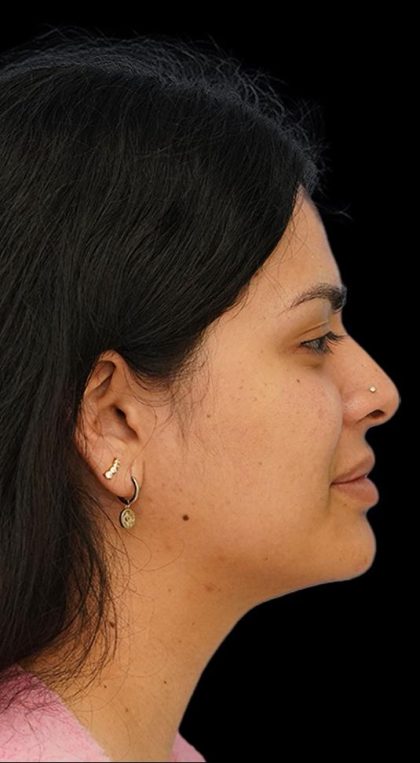 Chin Liposuction Before & After Patient #1557