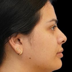 Chin Liposuction Before & After Patient #1557