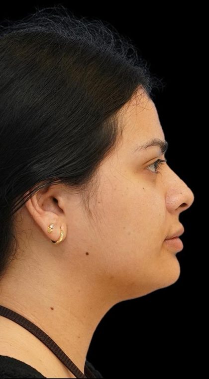 Chin Liposuction Before & After Patient #1557