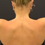Arm Liposuction Before & After Patient #1586
