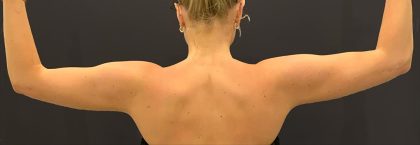 Arm Liposuction Before & After Patient #1586