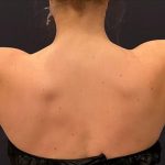 Arm Liposuction Before & After Patient #1586