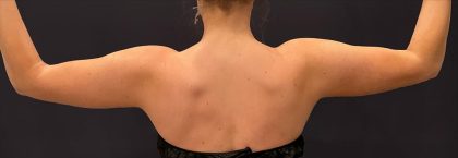 Arm Liposuction Before & After Patient #1586
