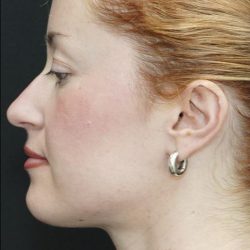 Chin Liposuction Before & After Patient #1558