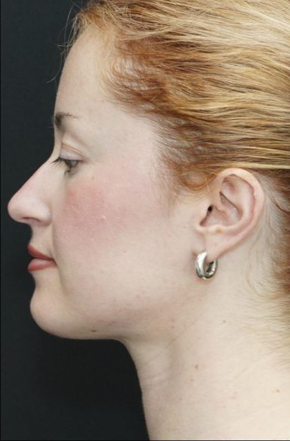 Chin Liposuction Before & After Patient #1558