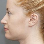 Chin Liposuction Before & After Patient #1558