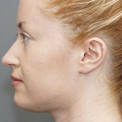 Chin Liposuction Before & After Patient #1558