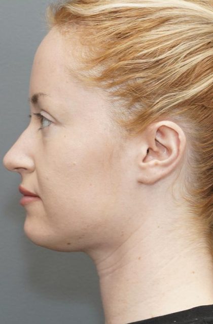 Chin Liposuction Before & After Patient #1558