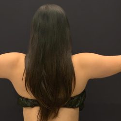 Arm Liposuction Before & After Patient #1587