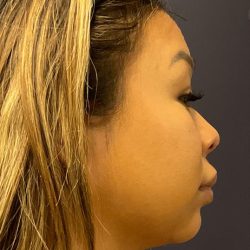 Chin Liposuction Before & After Patient #1559