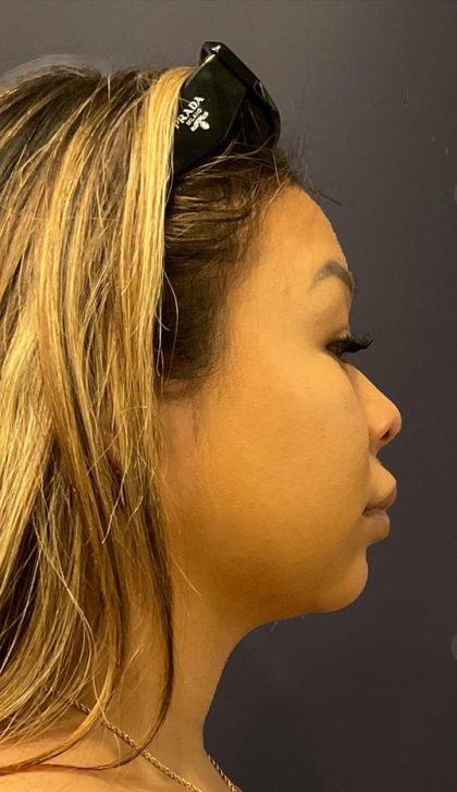 Chin Liposuction Before & After Patient #1559