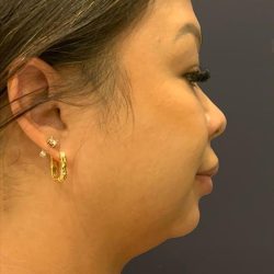 Chin Liposuction Before & After Patient #1559