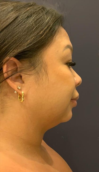 Chin Liposuction Before & After Patient #1559