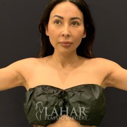 Arm Liposuction Before & After Patient #1588