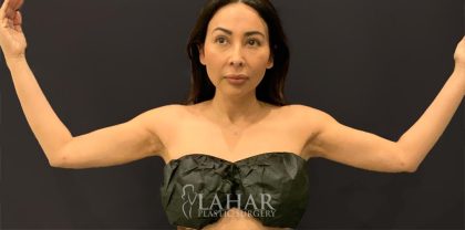 Arm Liposuction Before & After Patient #1588