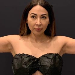 Arm Liposuction Before & After Patient #1588