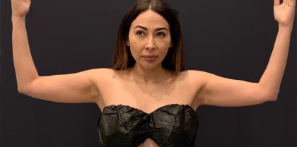 Arm Liposuction Before & After Patient #1588