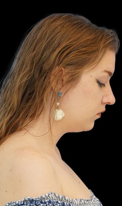 Chin Liposuction Before & After Patient #1560