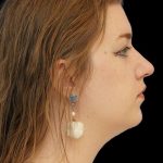 Chin Liposuction Before & After Patient #1560