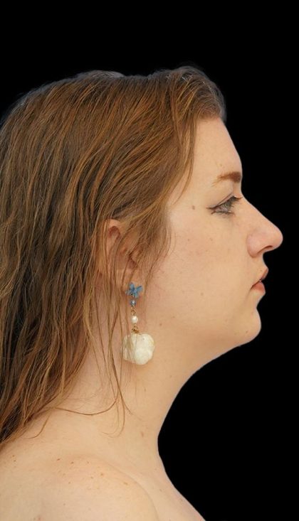 Chin Liposuction Before & After Patient #1560