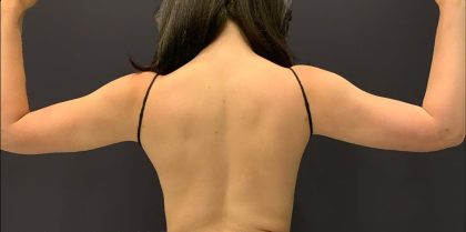 Arm Liposuction Before & After Patient #1589