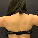 Arm Liposuction Before & After Patient #1589