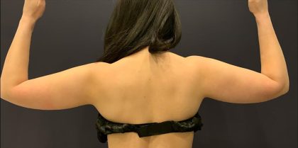 Arm Liposuction Before & After Patient #1589