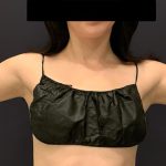 Arm Liposuction Before & After Patient #1589
