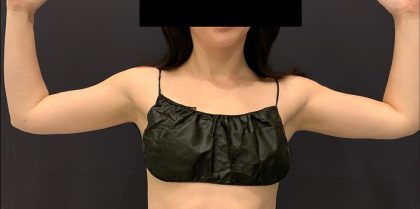 Arm Liposuction Before & After Patient #1589