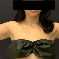 Arm Liposuction Before & After Patient #1589