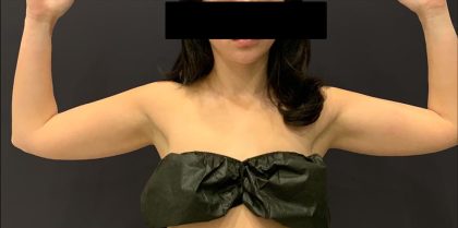 Arm Liposuction Before & After Patient #1589